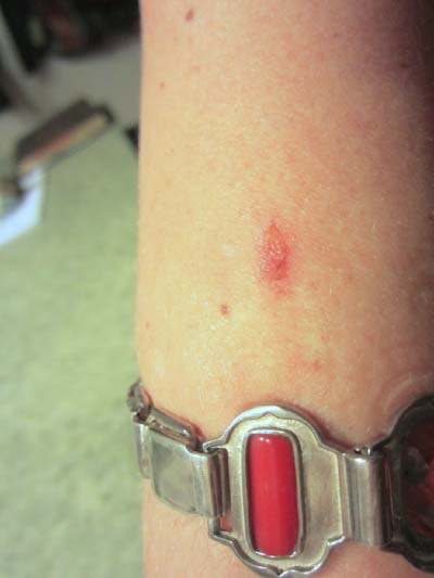 Rash possibly caused by frequency bangle